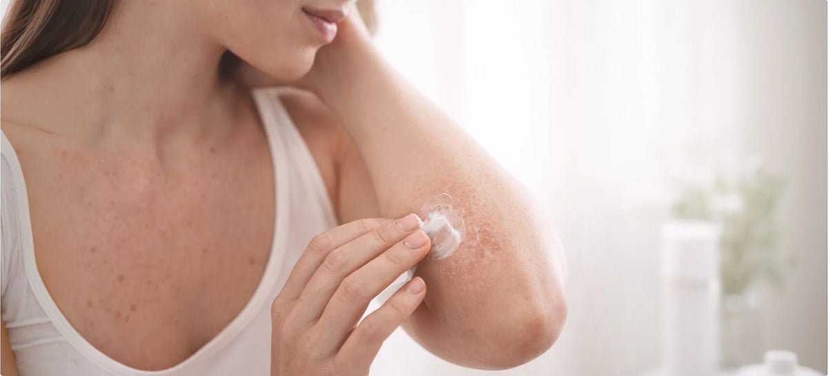 Atopic Dermatitis (Atopic Eczema)