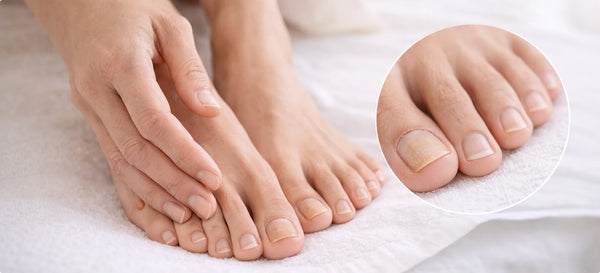 Onychomycosis: How to Recognize It Correctly, When It Becomes Chronic, and What Truly Matters