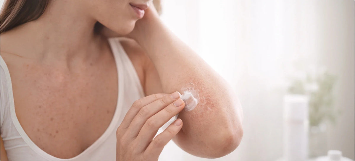 Atopic Dermatitis (Atopic Eczema)